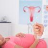 Hnedý výtok s hematómom počas tehotenstva Ako sa rieši hematóm počas tehotenstva