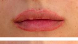 Крем за уплътняване на устни: как действа Хиалуронов мехлем за устни
