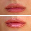 Cremă pentru repenarea buzelor: cum funcționează Unguent de buze hialuronic