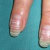 Причини за бели петна по ноктите и как да ги лекуваме