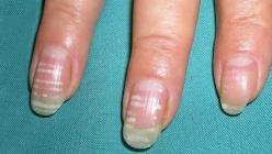 Причини за бели петна по ноктите и как да ги лекуваме